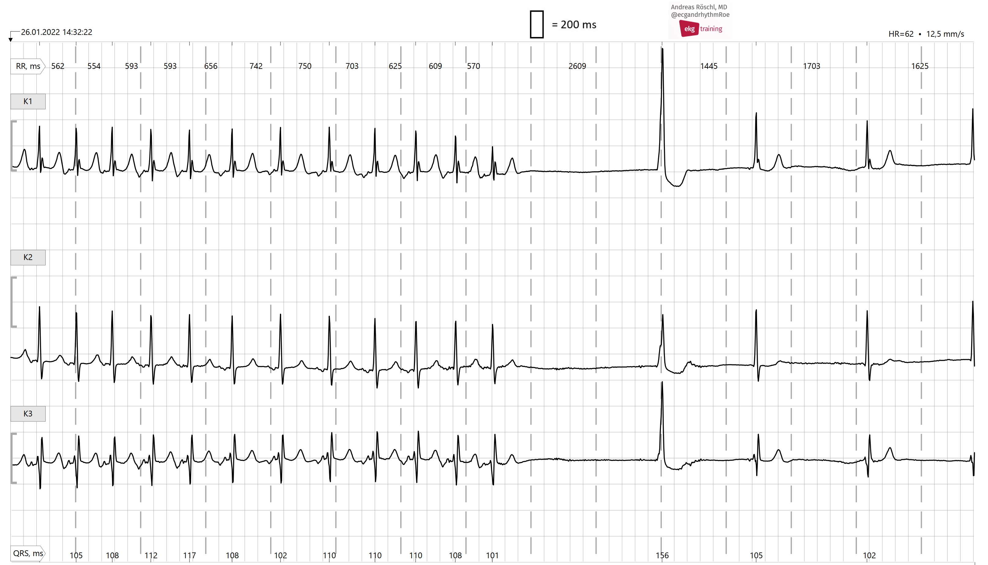 sick-sinus-syndrome-ecg-guru-instructor-resources